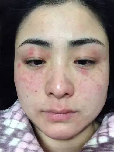 什么是干敏？什么是油敏？什么是激素敏？？