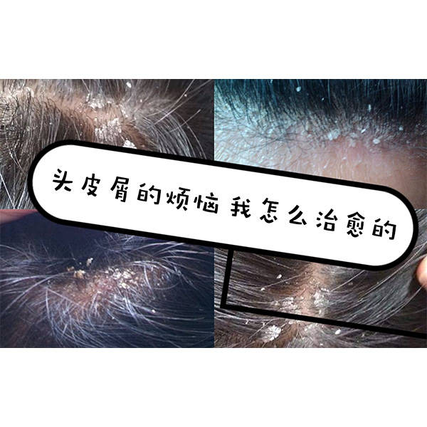 头发怎样去屑止痒?比较火的洗发水推荐